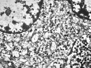 F,45y. | metastasis - carcinoid F,45y. | metastasis - carcinoid